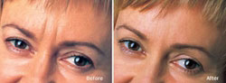 Dysport Before and After