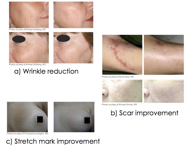 Laser Treatment Glendora CA