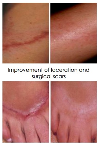 Laser Treatment Glendora