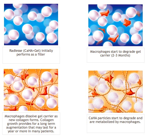 Radiesse Injectable Glendora