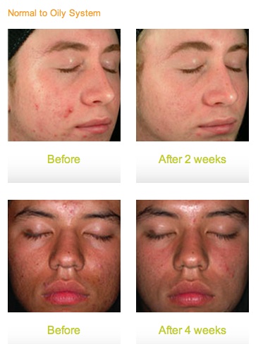 Acne Treatment Glendora CA