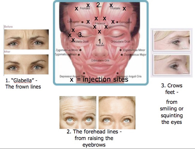 Botox Examples