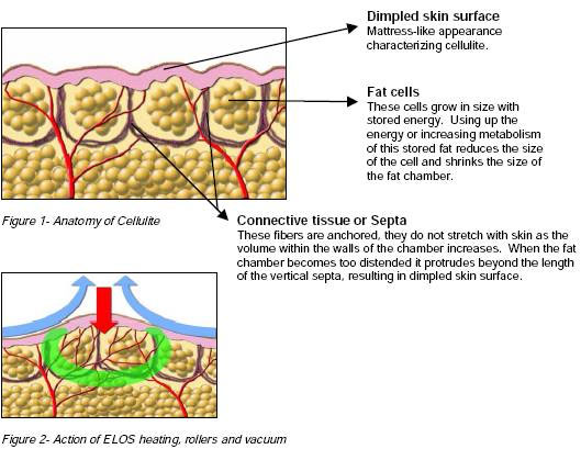 Velashape Treatment Glendora