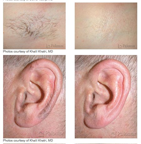 Laser Hair Removal