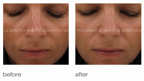 Chemical Peels Treatment Glendora