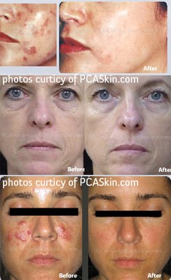 Chemical Peels Treatment Glendora