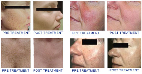 Photofacials Treatment Glendora