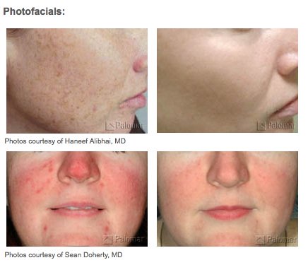 Photofacials Treatment Glendora
