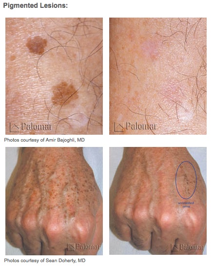 Photofacials Treatment Glendora