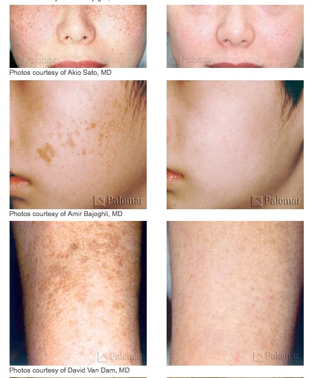 Photofacials Treatment Glendora, CA