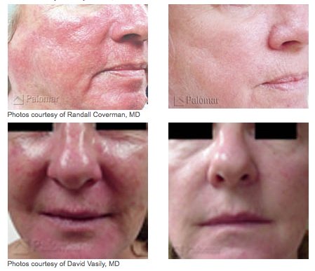 Photofacials Treatment Glendora