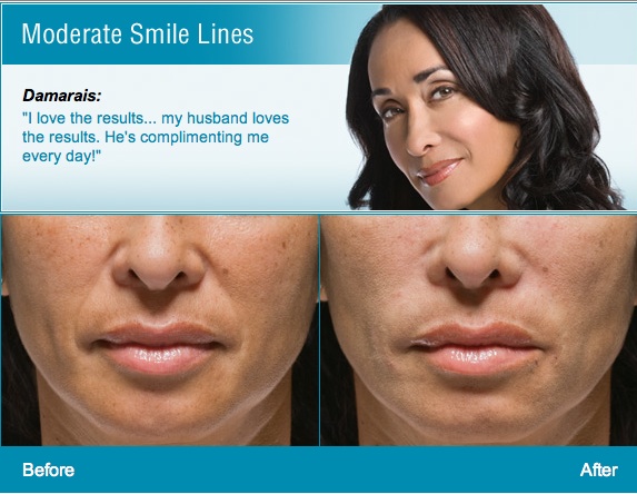 Radiesse Injectable Treatment Glendora CA