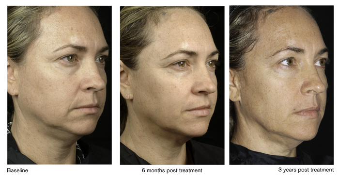 Thermage Treatment Glendora