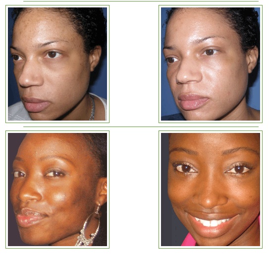 VI Peel Treatment Glendora