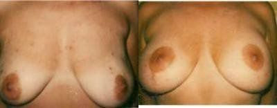 Breast Lift Treatment Glendora CA
