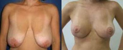 Breast Lift Treatment Glendora