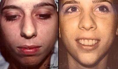 Facial Implants Glendora CA