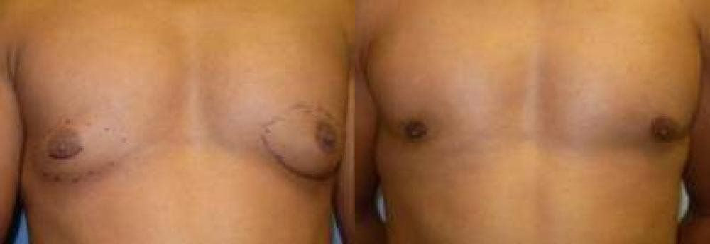 Male Breast Reduction Treatment Glendora