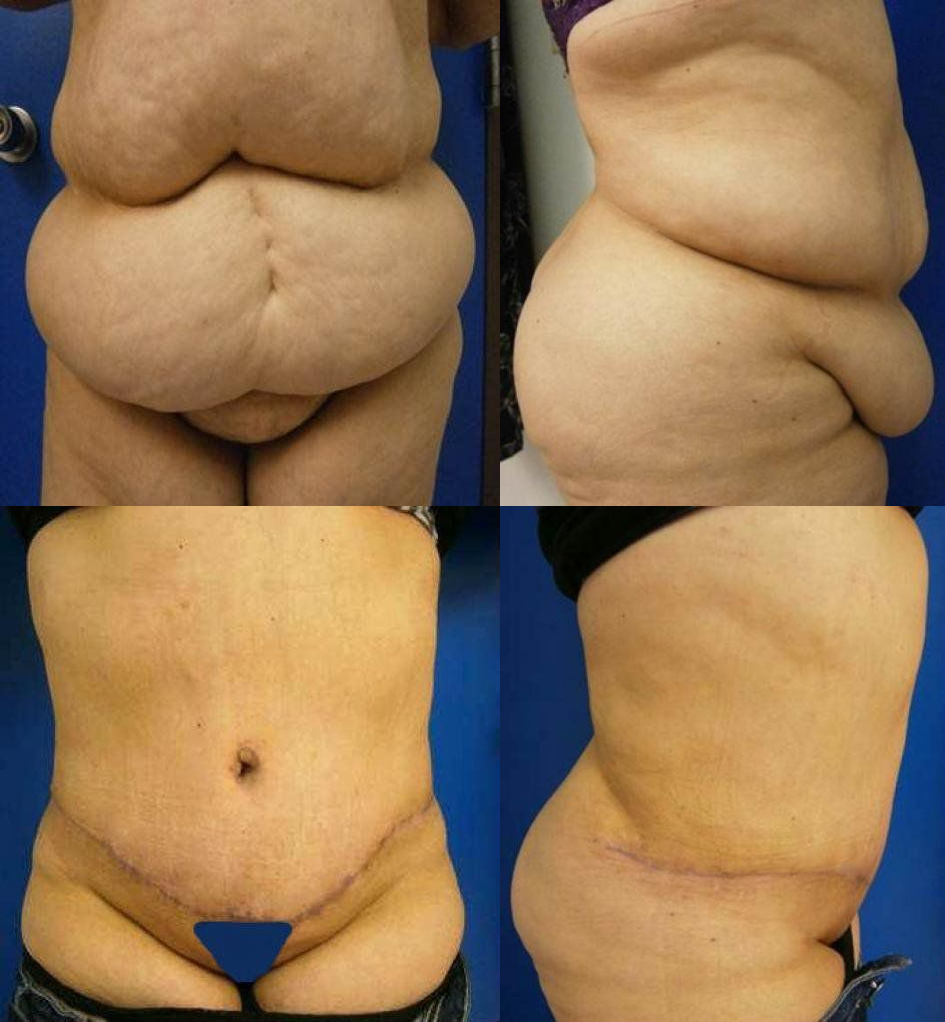 Abdominoplasty Treatment Glendora
