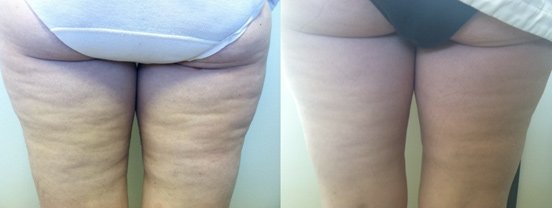VelaShape™ Before & After