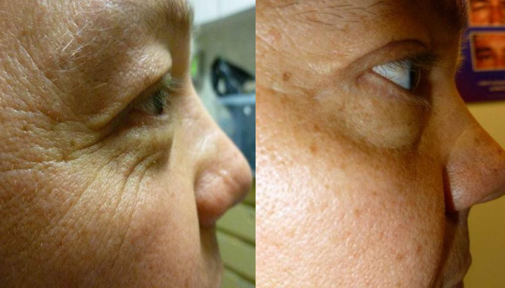 Eyelid Surgery Glendora CA