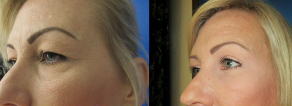Eyelid Surgery Glendora, CA