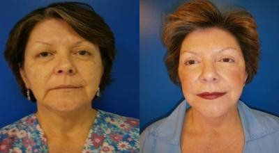 Facelift Treatment Glendora CA