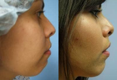 Facial Implants Glendora