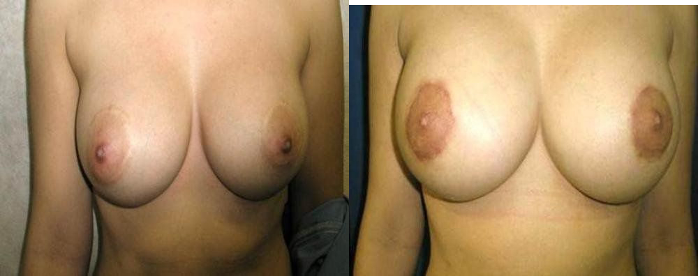 Breast Implant Exchange Glendora, CA