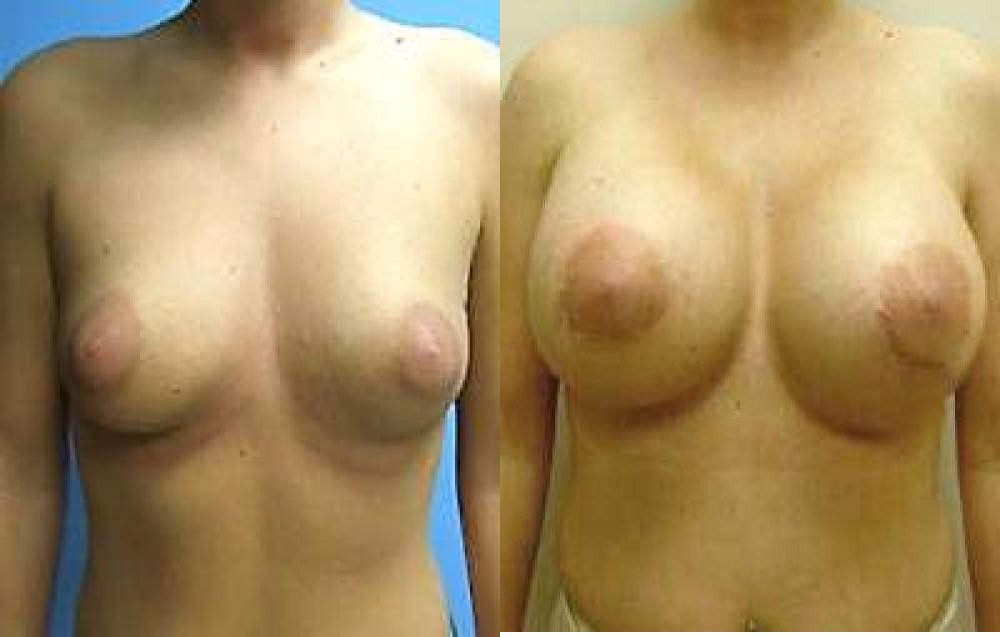 Breast Implant Exchange Glendora