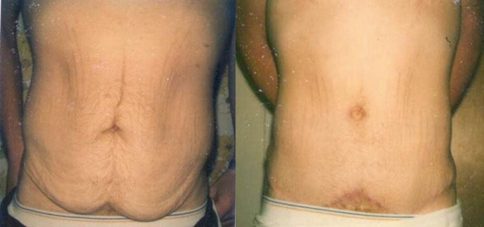 Male Tummy Tuck Procedure Glendora