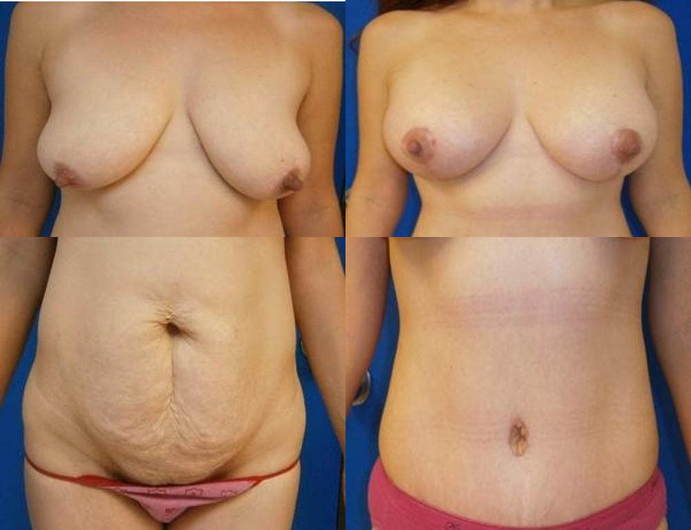 Mommy Makeover Glendora