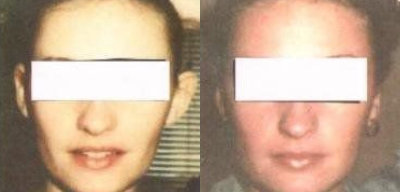 Otoplasty Treatment Glendora