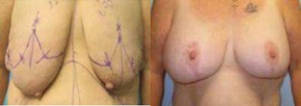 Breast Reconstruction Glendora