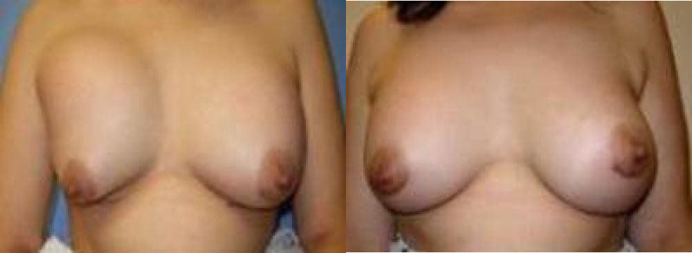 Breast Reconstruction Glendora CA