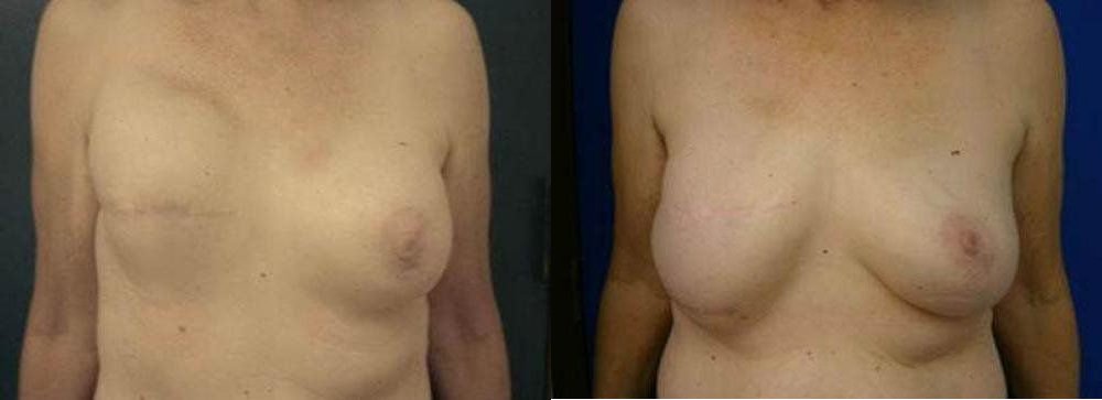 Breast Reconstruction Glendora, CA