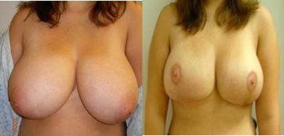 Breast Reduction Glendora