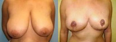 Breast Reduction Glendora CA