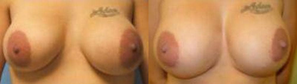 Breast Procedures Glendora, CA