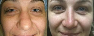 Rhinoplasty Treatment Glendora CA