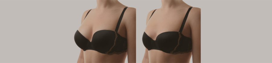 Breast Reduction