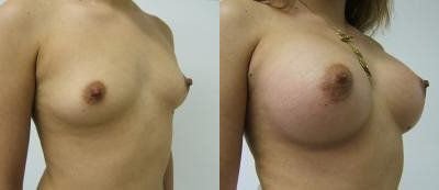 Breast Augmentation Glendora