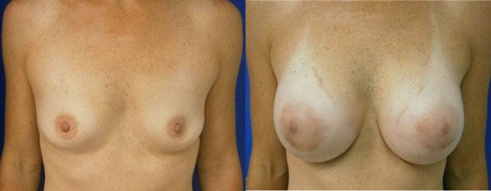 Breast Treatment Glendora