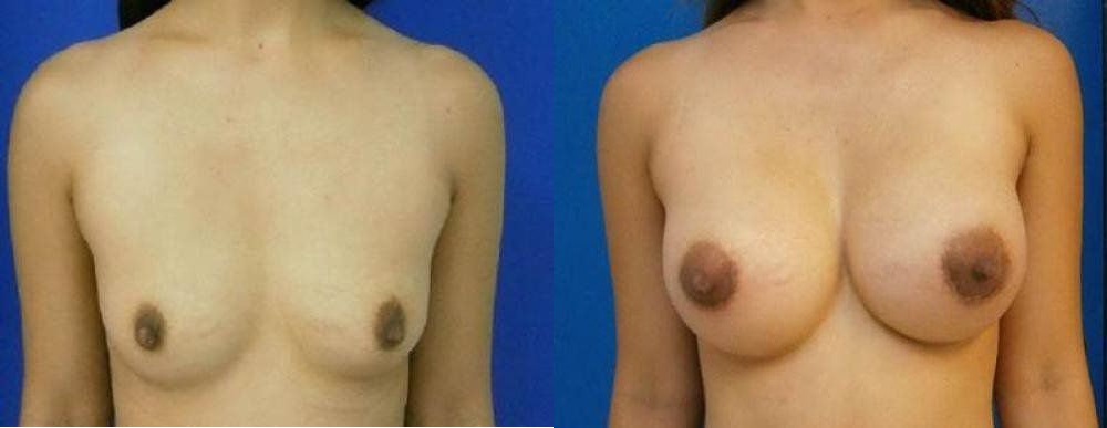 Breast Augmentation Procedures Glendora