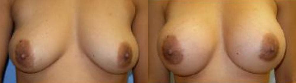 Breast Augmentation Treatment Glendora