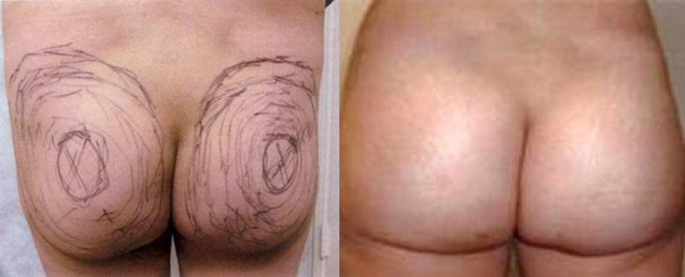 Brazilian Butt Lift Treatment Glendora CA