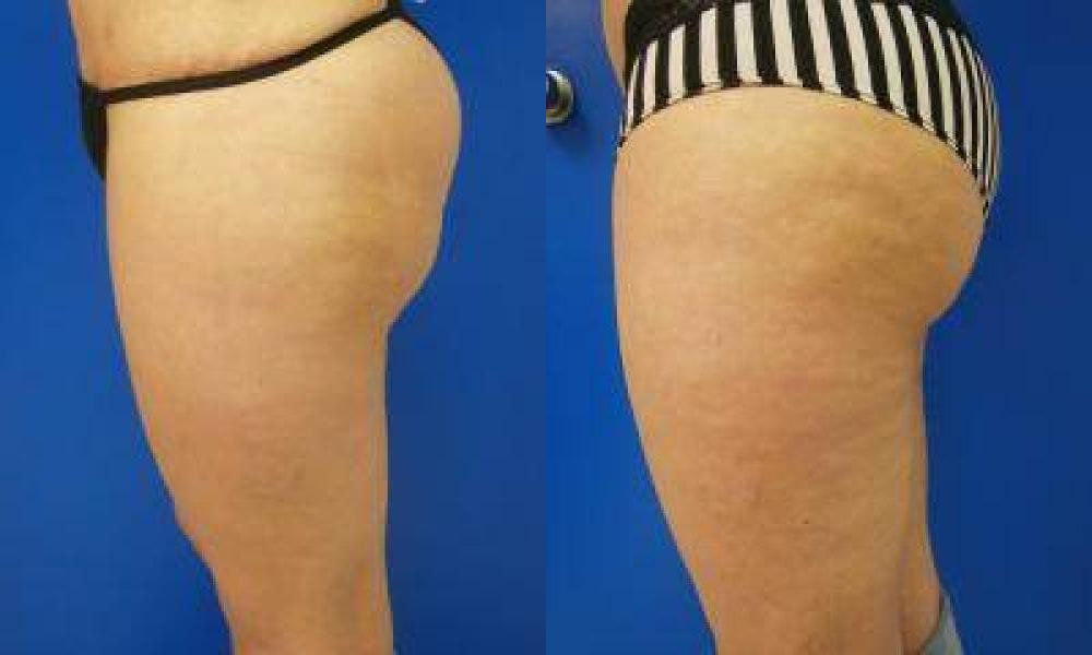 Brazilian Butt Lift Treatment Glendora